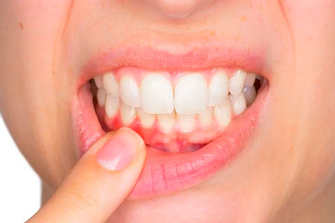 gingivitis enfermedad de las encías