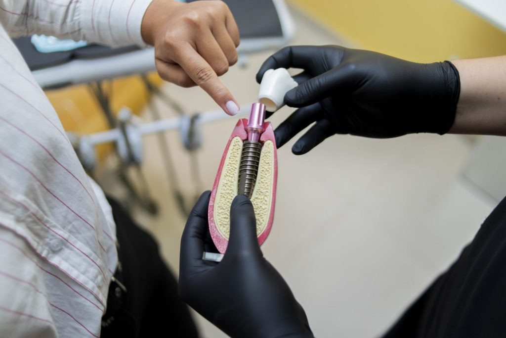 Foto de Implante dental en Lima Especialista en periodoncia e implantología oral