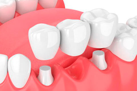 implantes dentales de prótesis puente fijo
