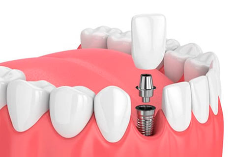 Implantes dentales de titanio