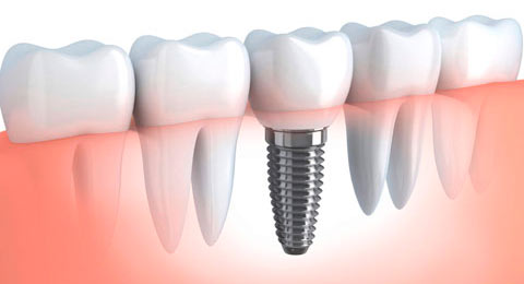 implantes dentales de titanio