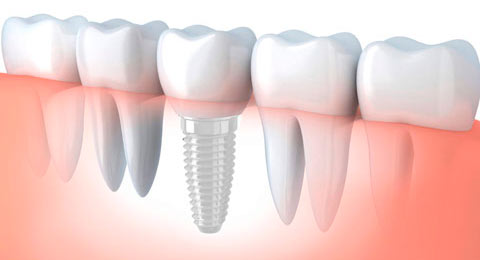 implantes dentales de zirconio