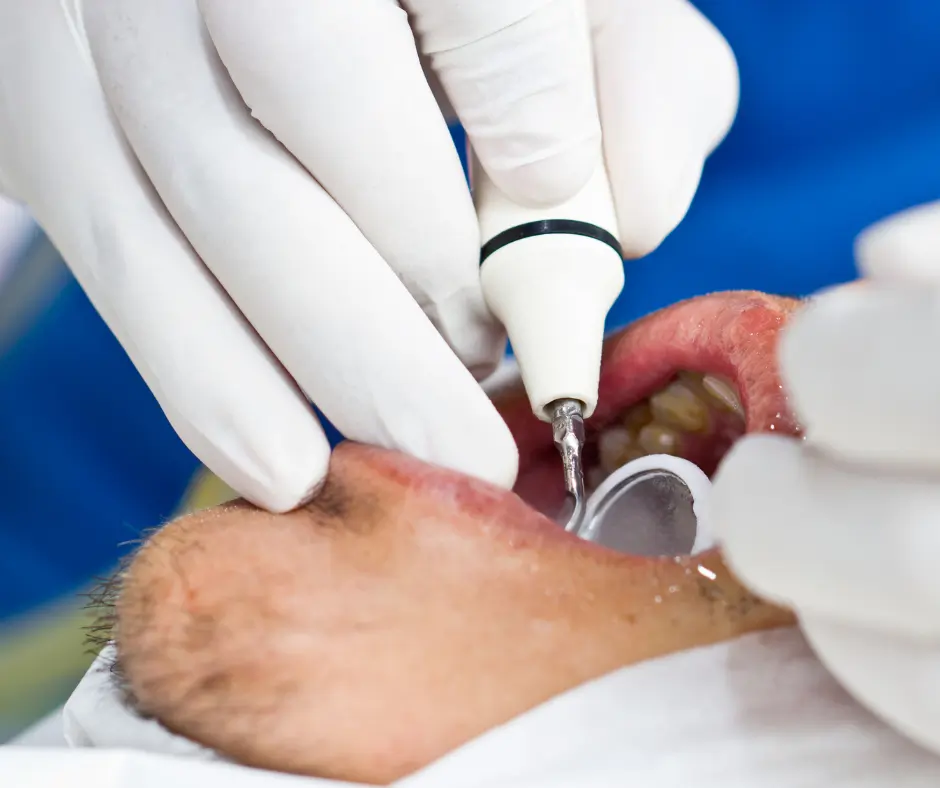 Periodontitis, encías sangrantes, enfermedad de encías. Especialista en periodoncia e implantes dentales en Lima