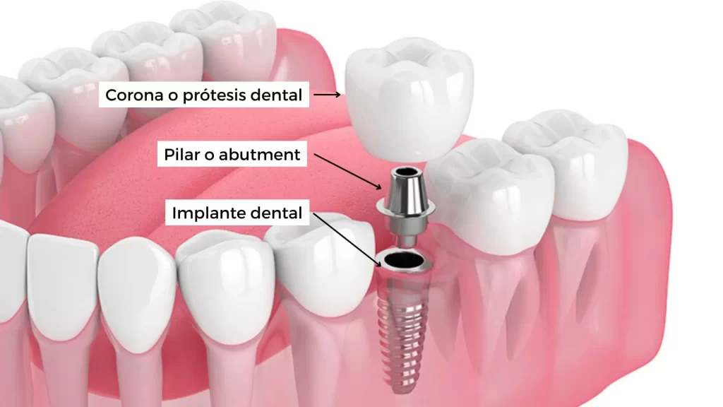 Partes de un implante dental en Lima Perú por un especialista en periodoncia e implantes o implantología oral