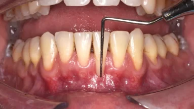 Retracción de encías en Lima por especialista dentista odontólog Juan Ceccarelli