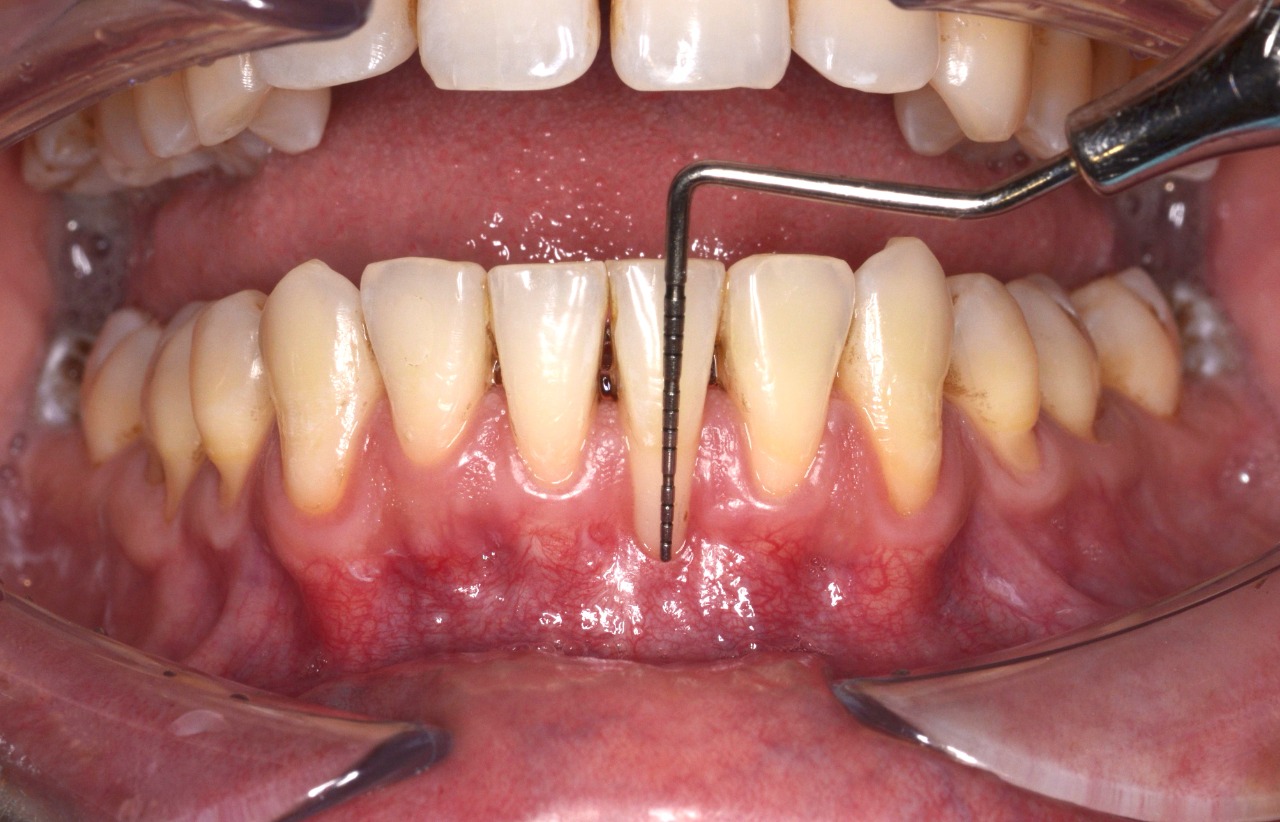 Retracción de encías en Lima por especialista dentista odontólog Juan Ceccarelli