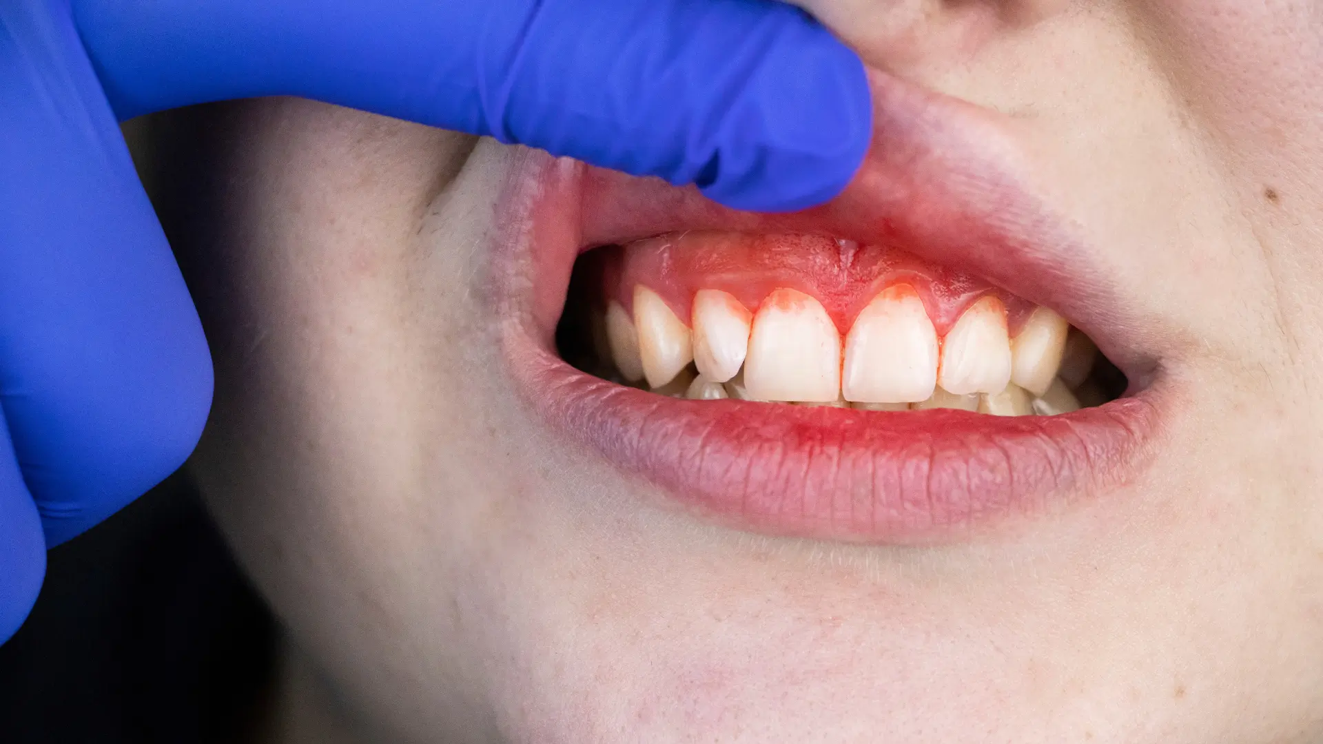 Encías sangrante sangrado de encías periodontitis diabetes clinica de encias