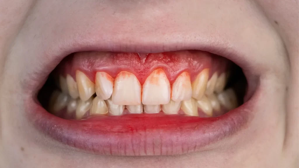 Un primer plano de la boca de una mujer con dientes rojos y blancos que muestran encías sangrantes.