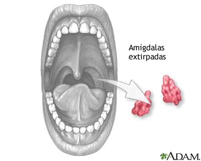 amigdalas inflamadas mal aliento halitosis www.clinicadeencias.pe Clínica de Encías | Mal aliento e Implantes Dentales Lima Jirón Monterrey N° 355, Lima 15038 Santiago de Surco - Lima - Perú Teléfono: +51 992 220 516