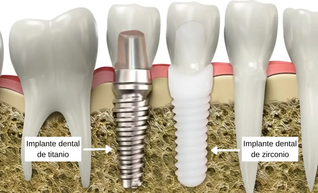 Implantes dentales de titanio versus implantes dentales de zirconio en Lima Perú
