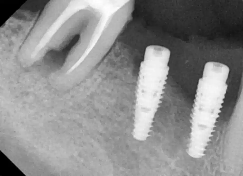Implantes dentales complicaciones hueso Especialista Lima Perú