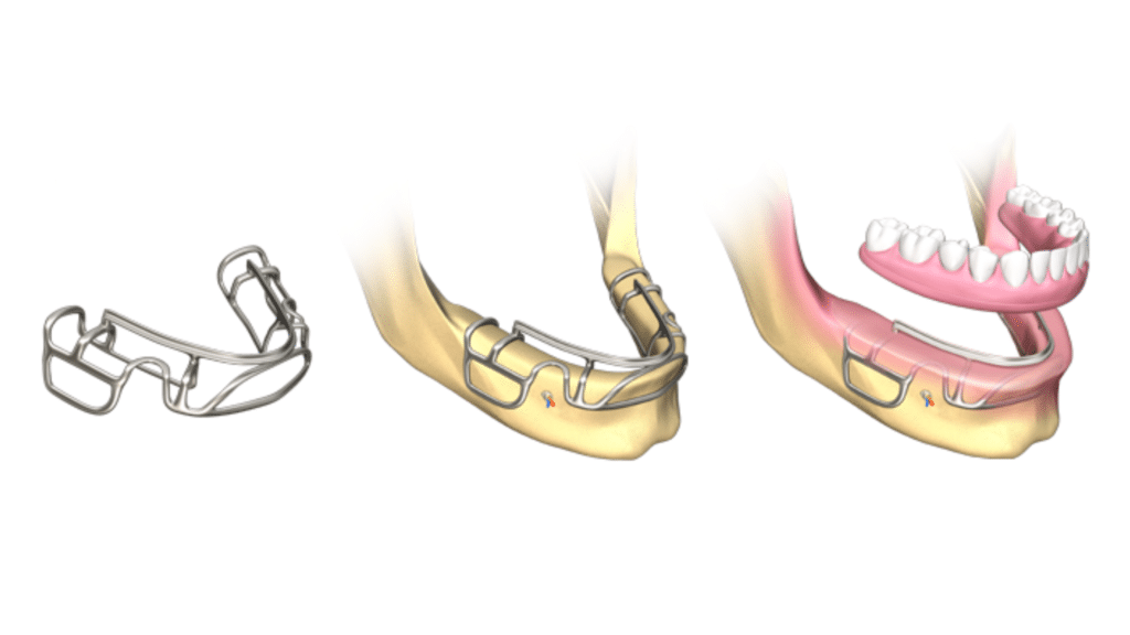 Implantes subperiósticos optimizado y geolocalizado