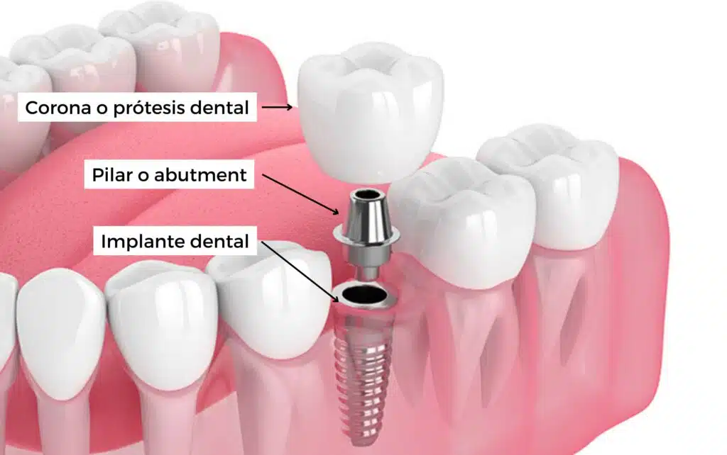 Partes prótesis implantes dentales Lima Perú Especialista
