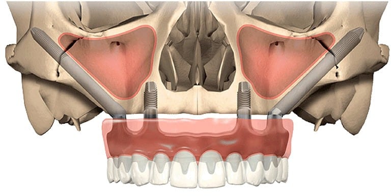 implantes cigomáticos optimizado y geolocalizado