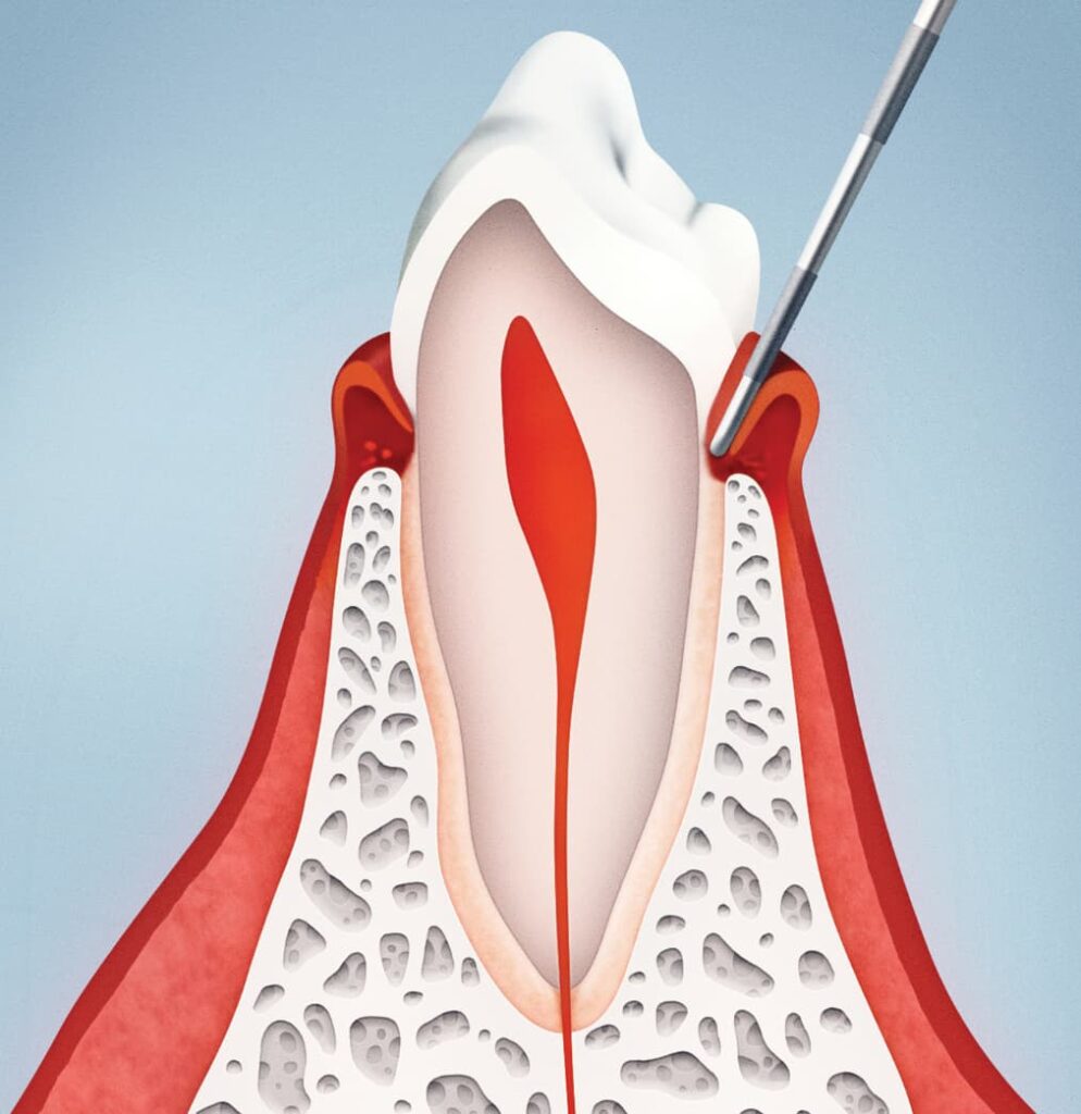 Agrandamiento de encías agrandadas especialista periodoncia lima