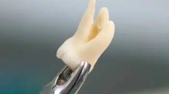 Extracción dental o exodoncia