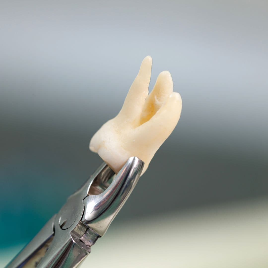 Extracción dental o exodoncia