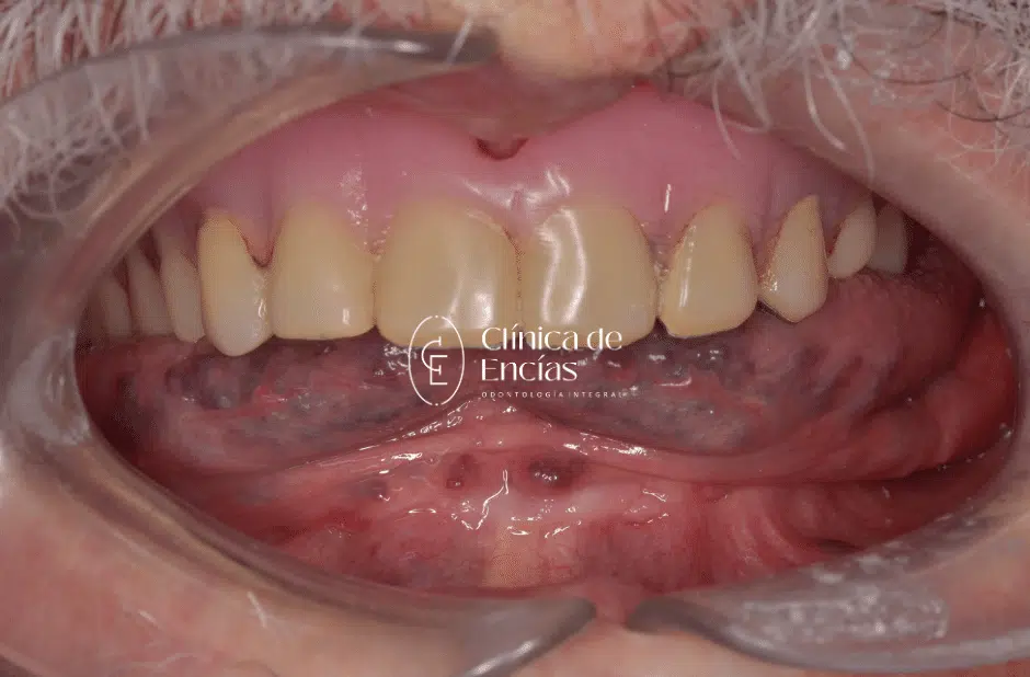 Implante dental Lima Perú Especialista en Periodoncia e implantología oral Clínica Dental Lima