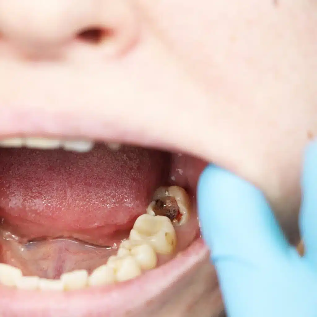 Tratamiento de encías y caries dental en Lima por especialista en periodoncia e implantología oral