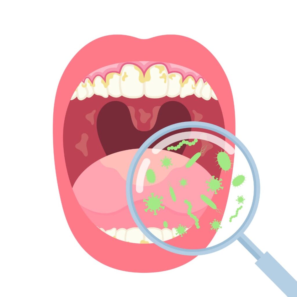 Lengua bacterias Tonsilolitos mal aliento dentista odontólogo especialista Lima Perú