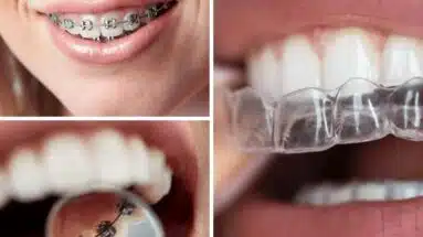Ortodoncia en adultos en Surco Lima Perú Especialistas odontólogos dentistas
