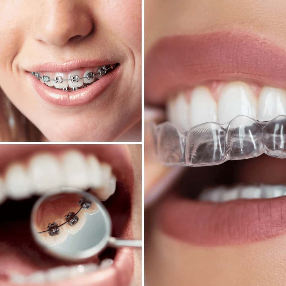 Ortodoncia en adultos en Surco Lima Perú Especialistas odontólogos dentistas