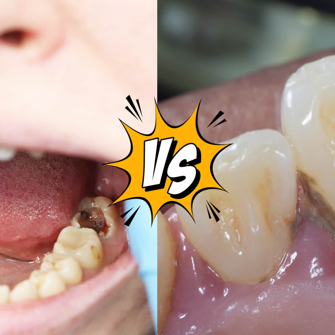 Tratamiento de encías y caries dental en Lima por especialista en periodoncia e implantología oral