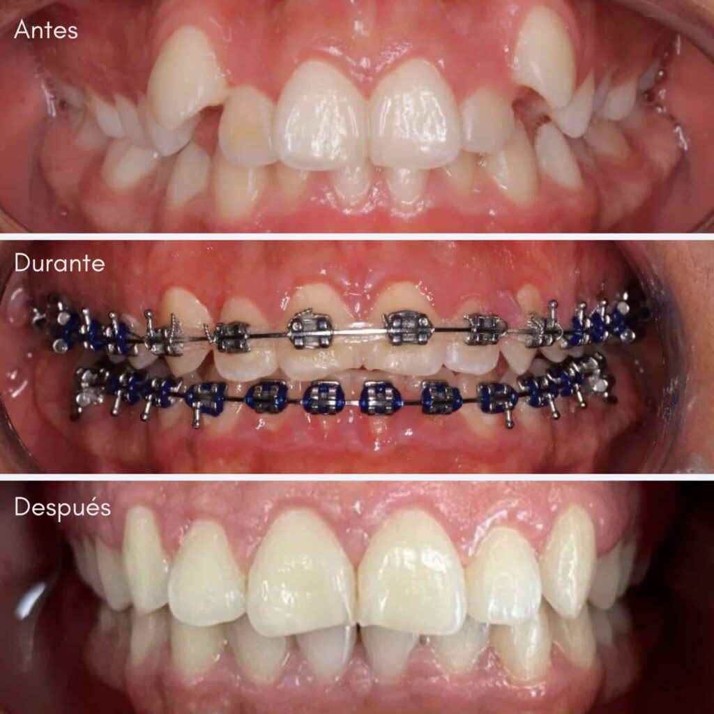 Ortodoncista en Lima ofreciendo brackets antes y después.