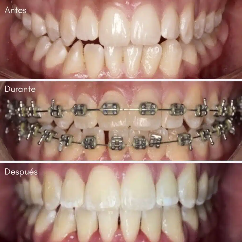Ortodoncista en Lima brindando brackets antes y después.