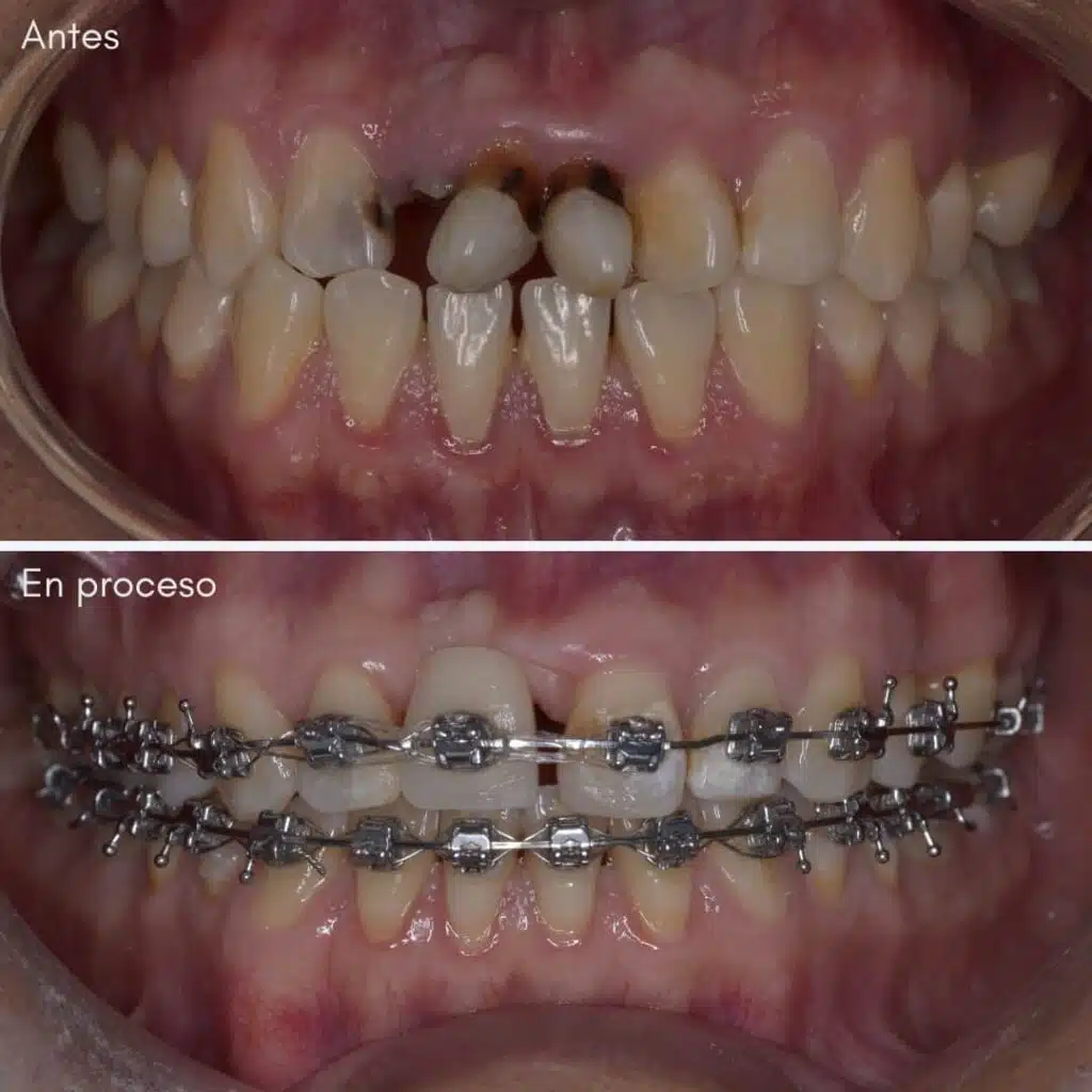 Ortodoncista en Lima - Brackets en el mundo.