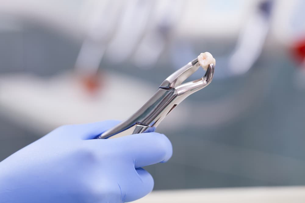 Extracción dental por especialista Lima Clínica de encías