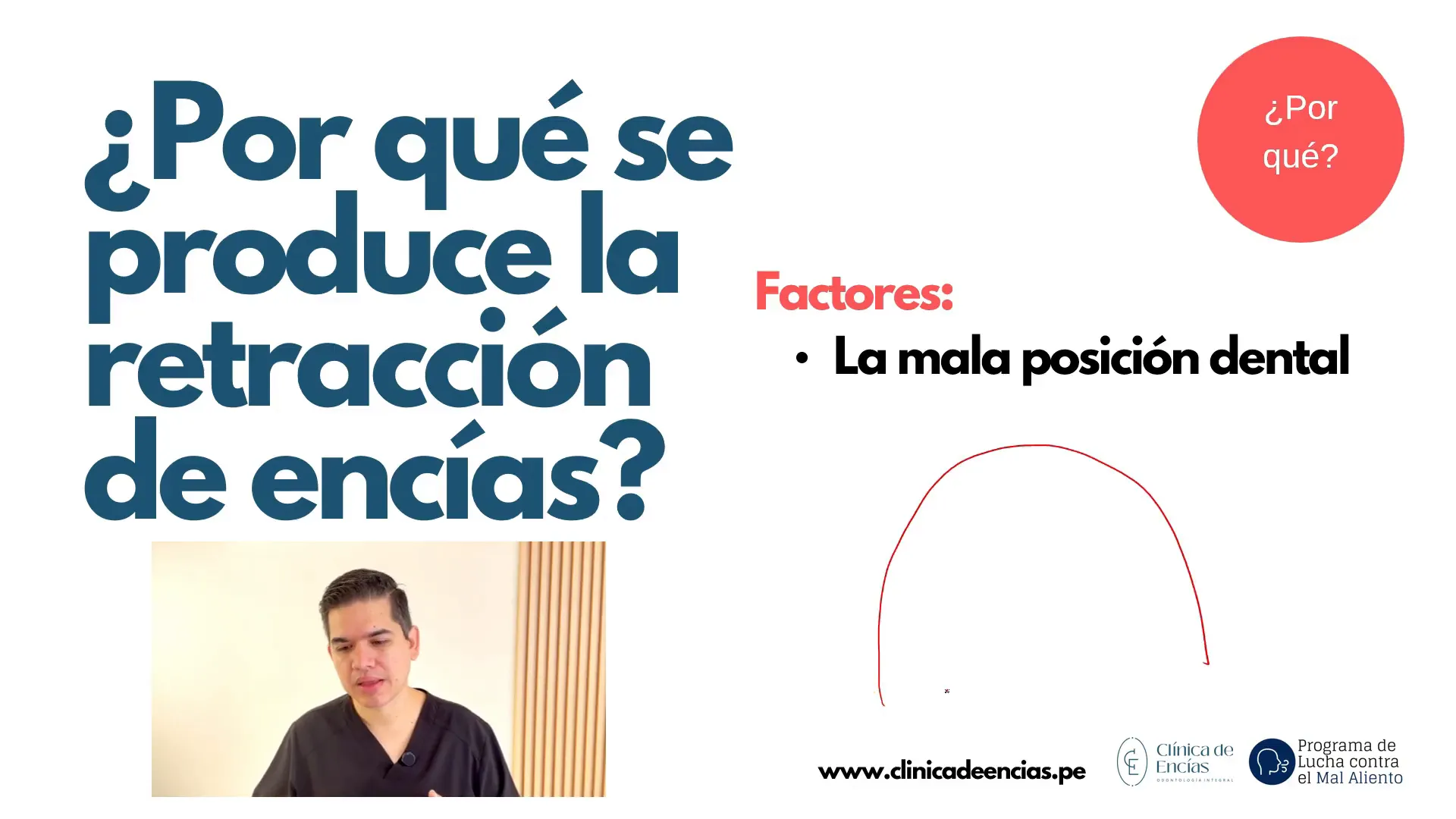 Dibujo de dientes mal posicionados y retracción de encías