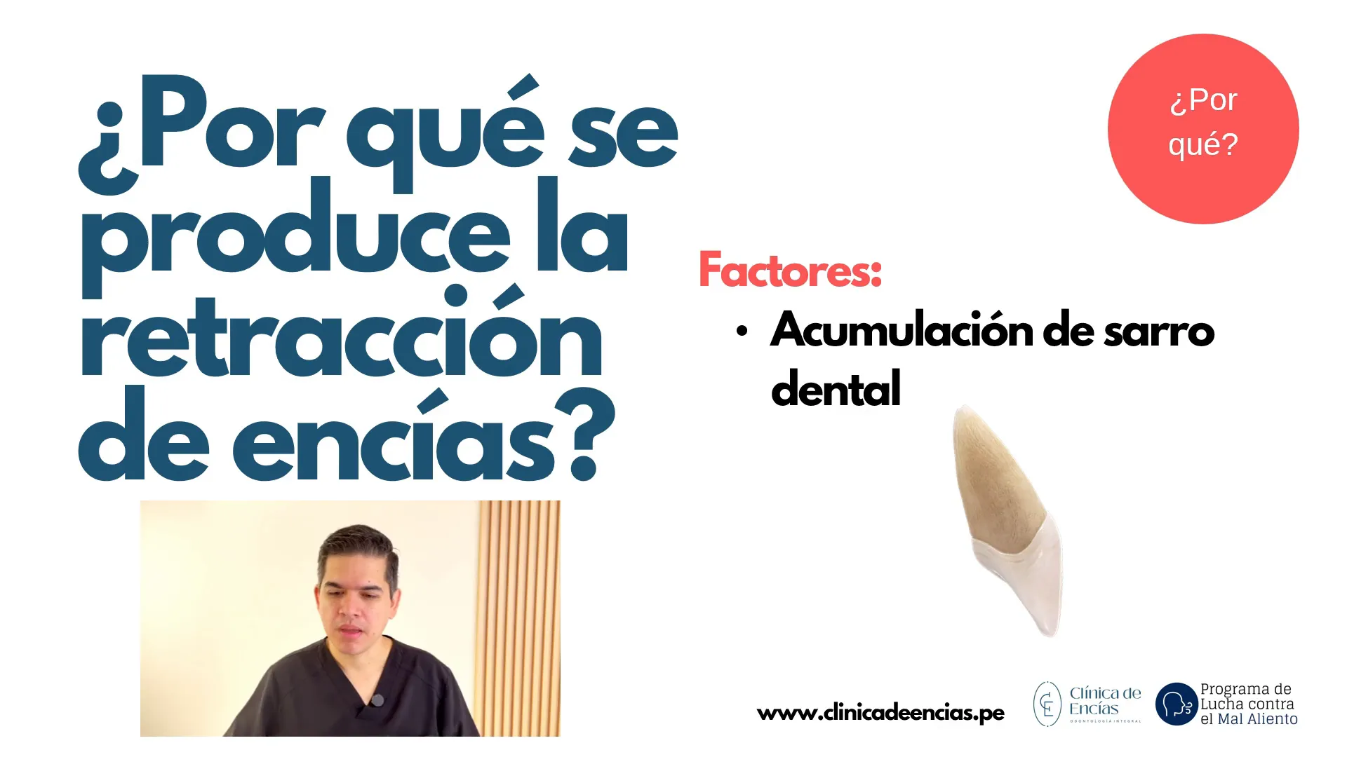 Acumulación de placa bacteriana en la encía