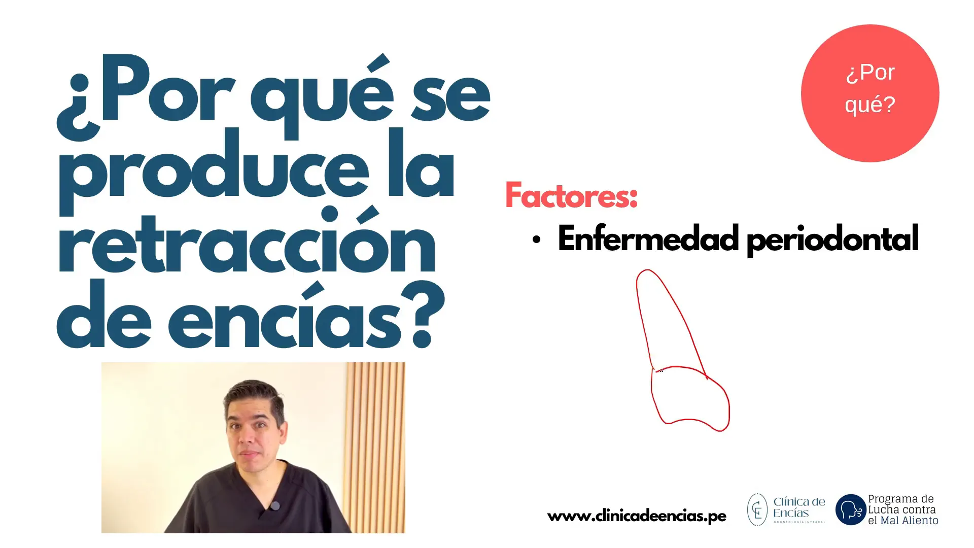 Ilustración de enfermedad periodontal y retracción de encías