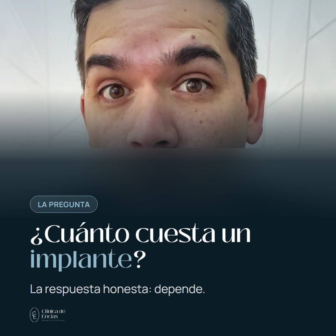 ¿Cuánto cuesta un implante dental? Depende de tu hueso