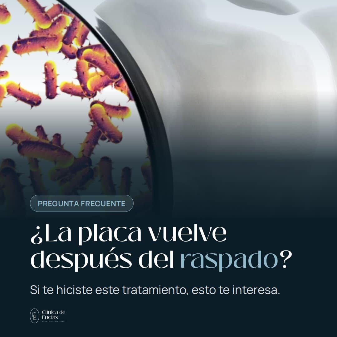 ¿La placa bacteriana vuelve después del raspado y alisado radicular?