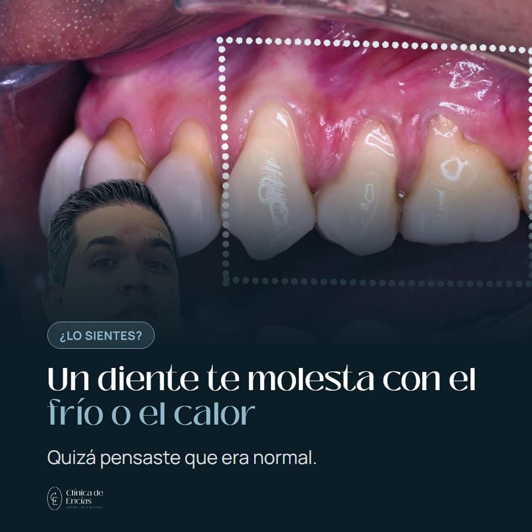 Encías retraídas y sensibilidad dental: qué hacer