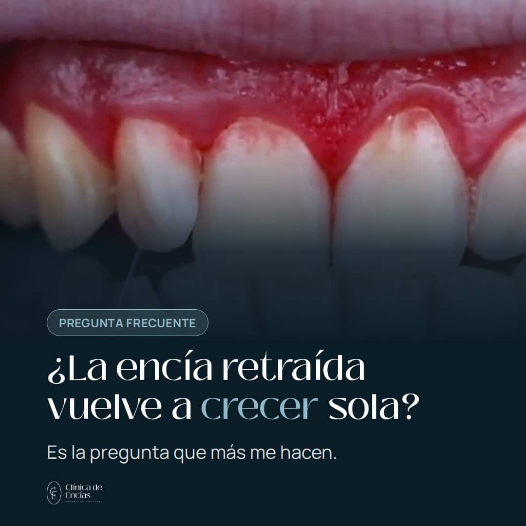 ¿La encía retraída vuelve a crecer sola?