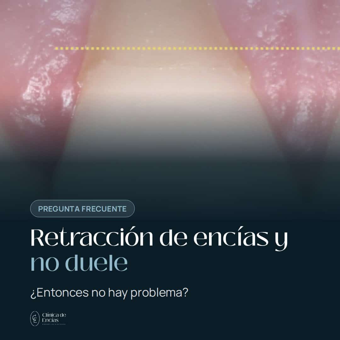 ¿Retracción de encías en dos dientes y no te duele?
