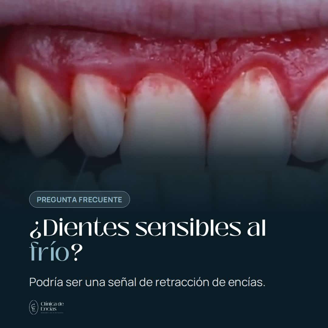 ¿Sientes los dientes sensibles al frío? Podría ser tu encía